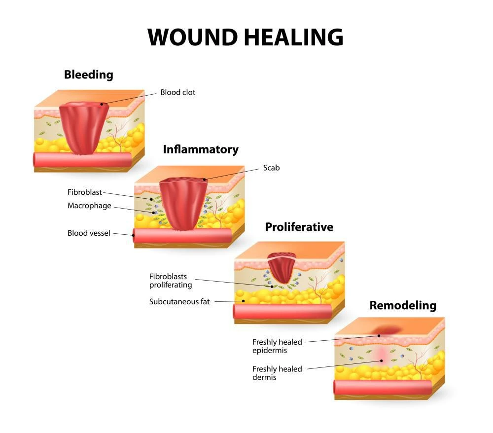wound infection healing
