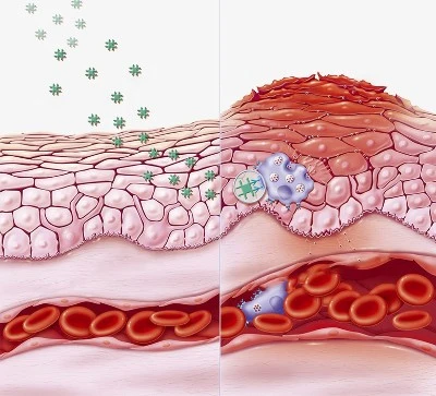 Reducing Inflammation Reducing Inflammation