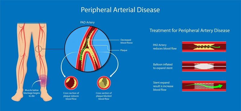 Peripheral Arterial Disease Peripheral Arterial Disease